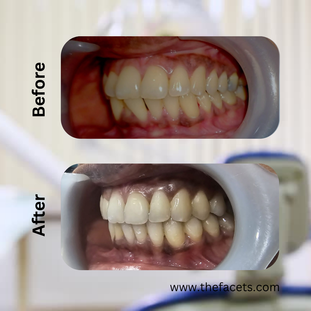 Before After Result 6